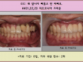 앞니 심미보철- 삐뚤고 어긋난 앞니 지르코니아 크라운 장착 전/후 사진입니다