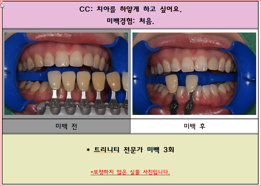 치아미백 전/후 사진입니다^^ 17