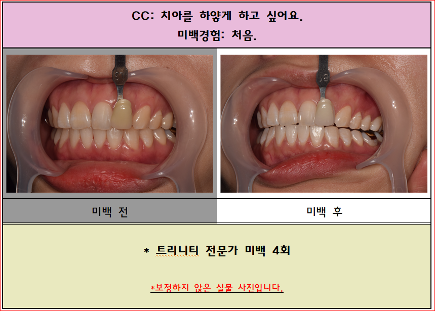 치아를 하얗게 하는 미백치료. 트리니티 미백 하루2시간이면 가능합니다^^