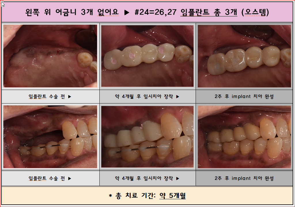 왼쪽 위 치아 3개가 없으셨는데 임플란트 시술로 치아 4개 완성~^^