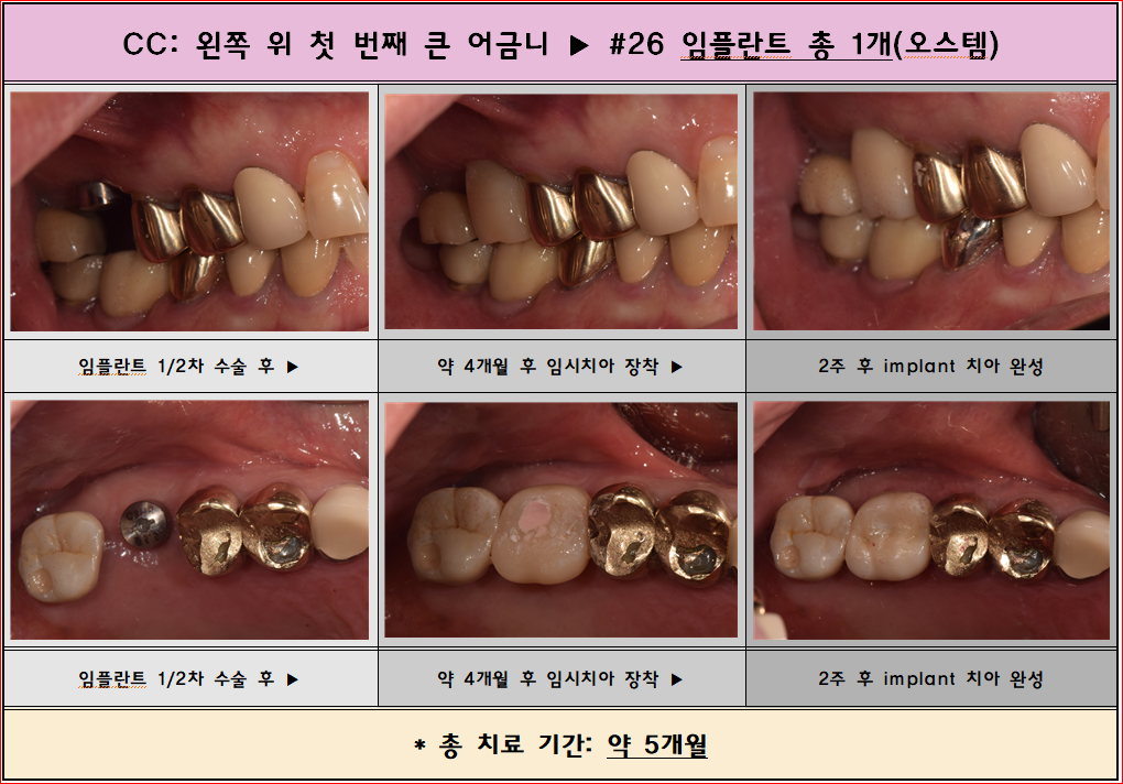 왼쪽 위 첫번째 큰 어금니 임플란트 전/후 포토입니다.