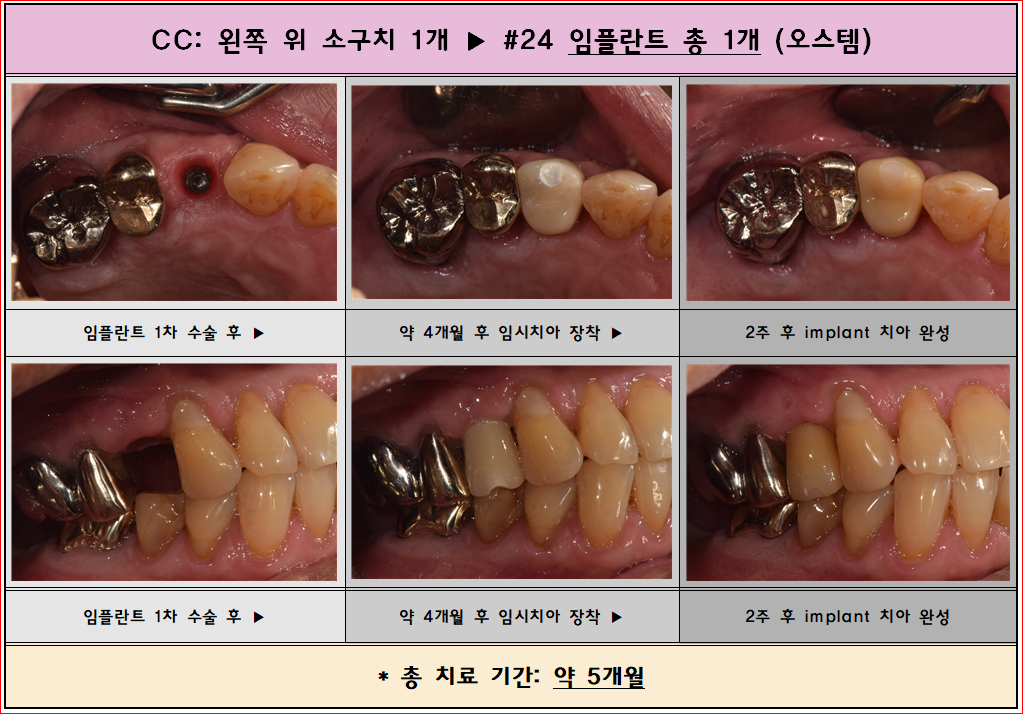 작은어금니가 흔들려서 발치하시고 임플란트 적용한 케이스입니다.