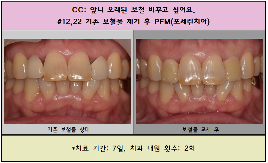 오래된 앞니 보철물 제거 후 PFM 하셨습니다.