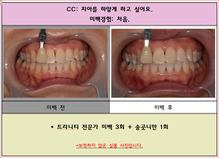치아미백 전후