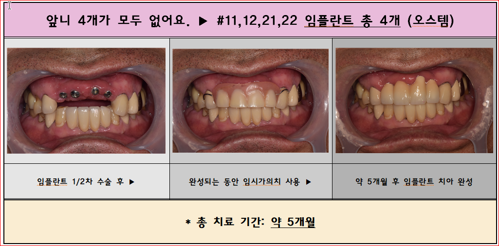 앞니 4개가 모두 빠져서 고민이셨던 분. 임플란트 4개식립 후 환한 미소를 되찾으셨습니다^^