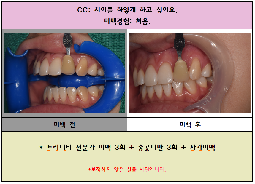 다른데는 치아가 하얀데, 송곳니만 색깔이 노래요! 이런경우도 부분 미백 가능합니다^^