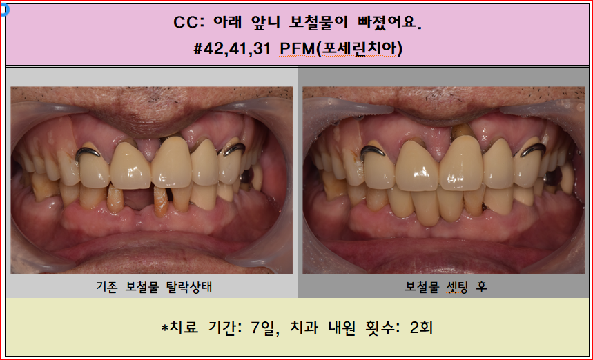 아래 앞니 보철물이 탈락했어요. 새로 제작하셨습니다.