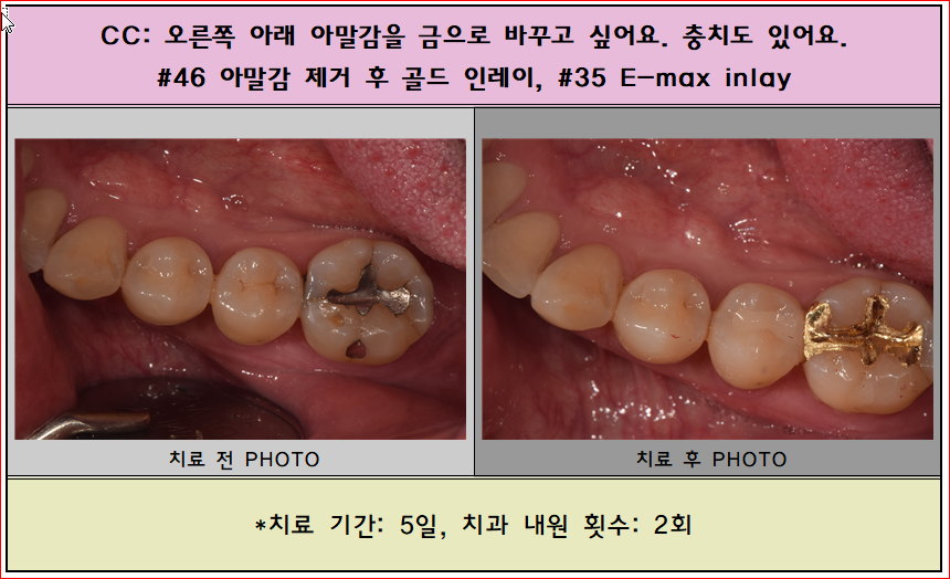 아말감을 금으로 바꾸면 이렇게 되요^^