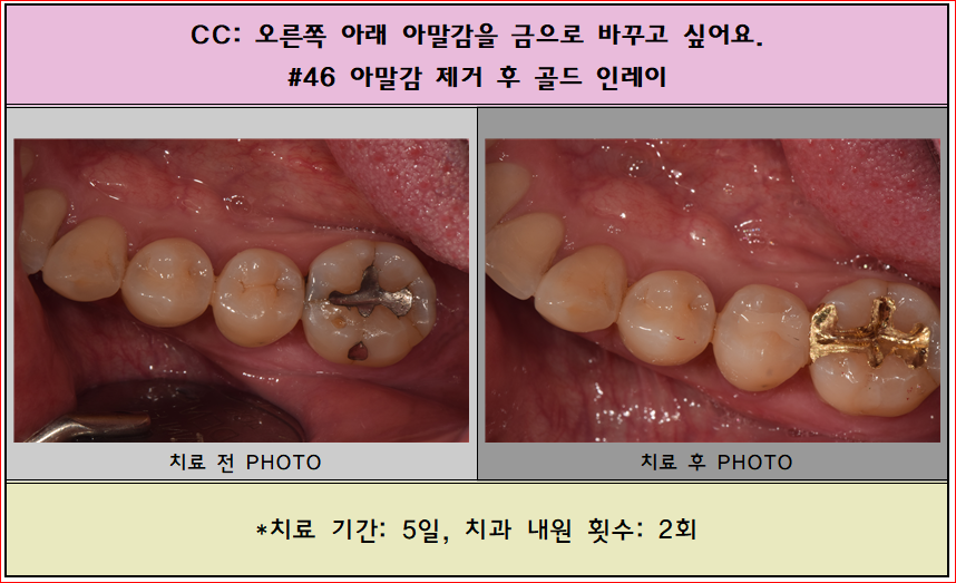 아말감 부위 제거 후 골드인레이 셋팅하였습니다^^