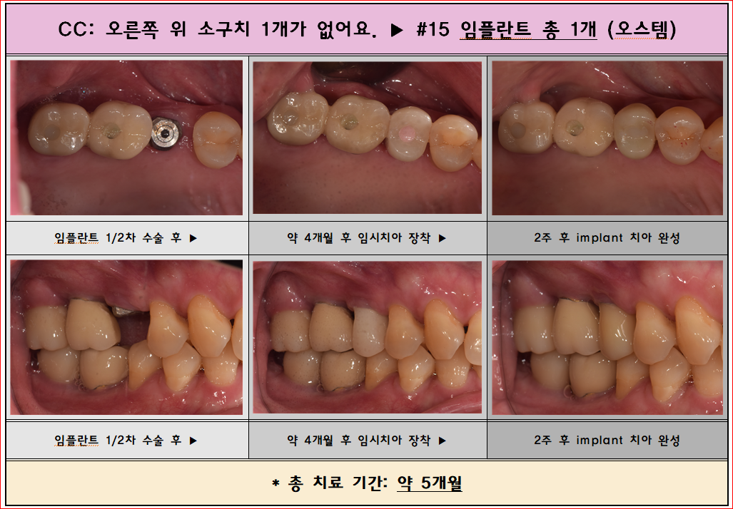 오른쪽 위 소구치가 없으셨어요. 임플란트 후 5개월 모습입니다.