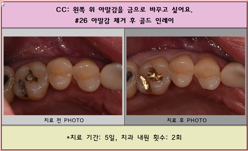 아말감에 충치가 생겨서 금으로 때우고 싶었어요.