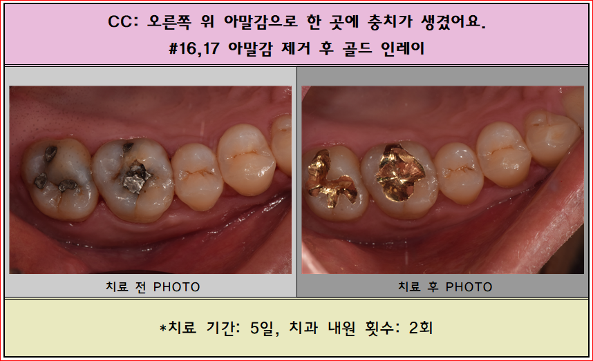 어렸을 때 아말감으로 때운 부위에 충치가 생겼어요.